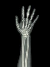 X-ray image of hand for bones concept